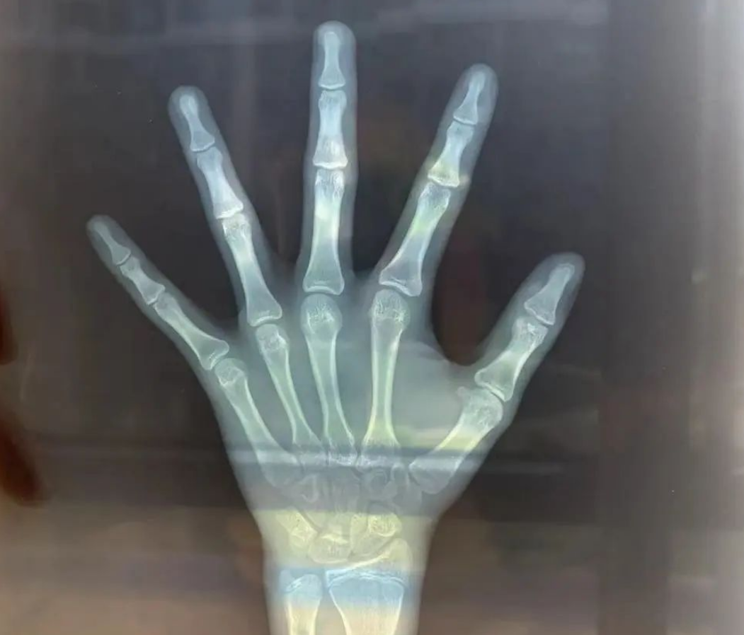 Real Mom Story: One More Inch at Bone Age 16. Our $4,000 Gamble
